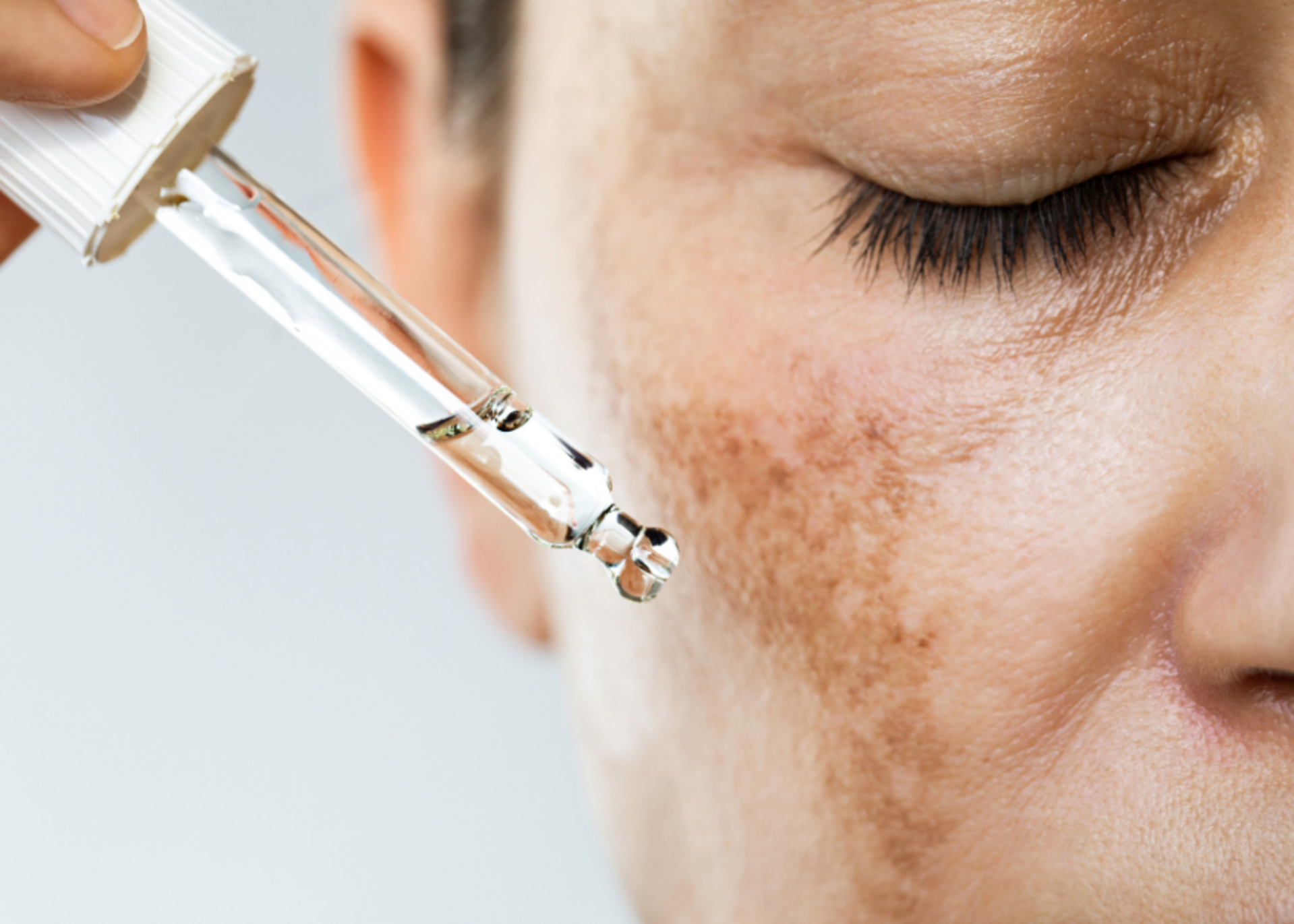 Melasma