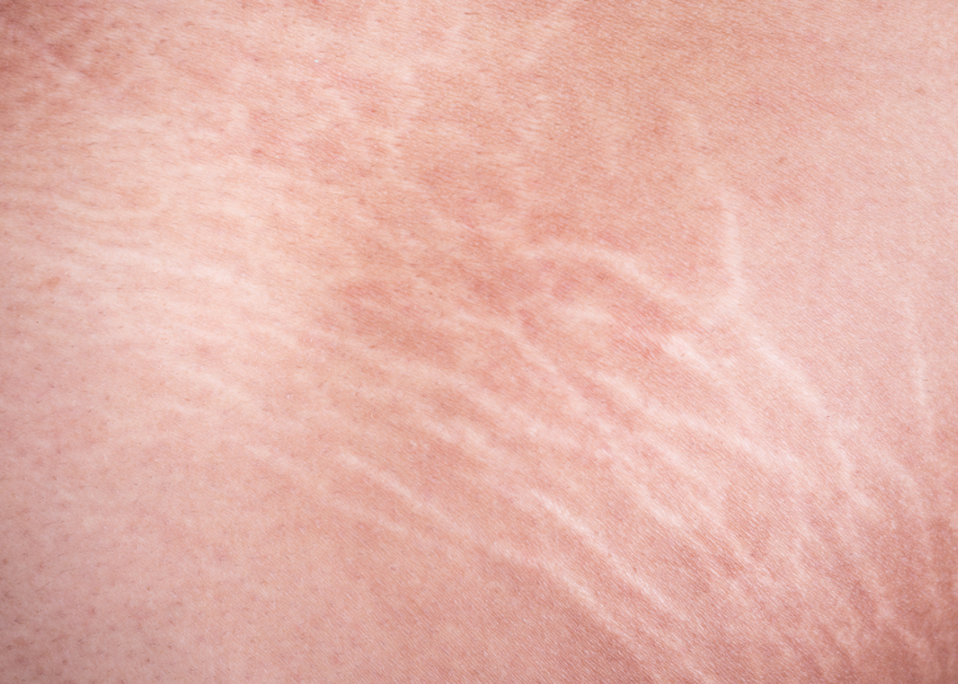 Stretch Mark
