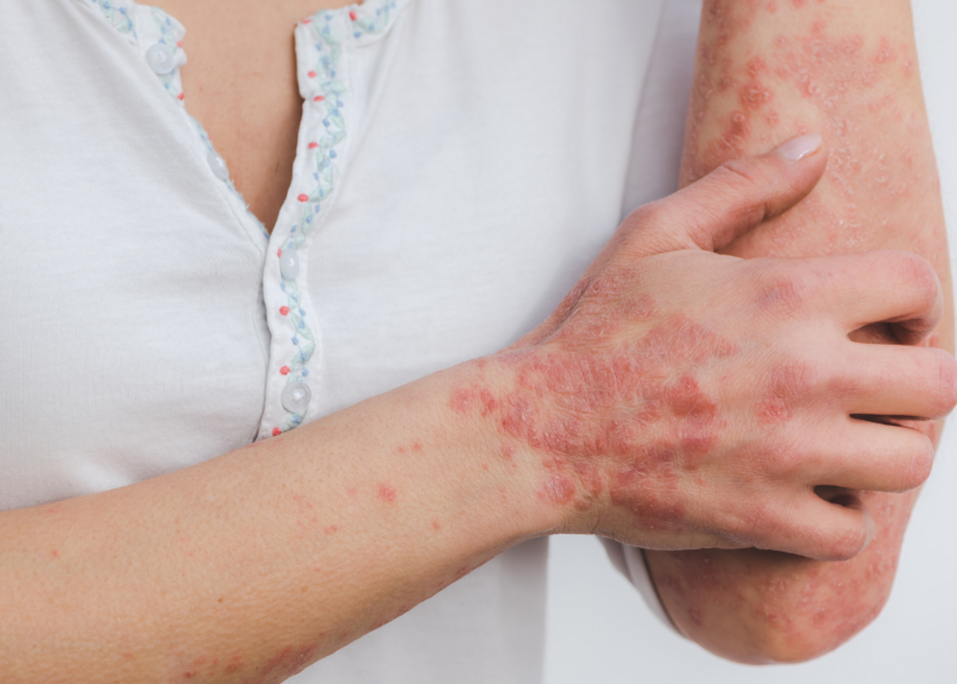 Psoriasis